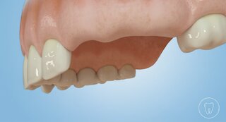 Brücke auf zwei Implantaten @