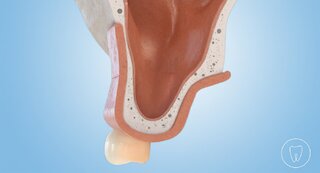 externer Sinuslift @