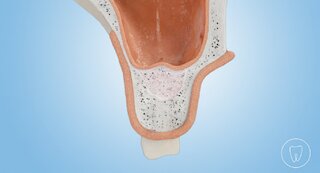 interner Sinuslift @