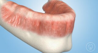 Prothese mit Stegverbindungen auf Implantaten @