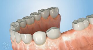 Schablonennavigierte Implantation @