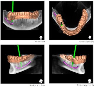3D navigierte Implantate Zahn @ 
