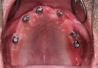Oberkiefer Implantate @
