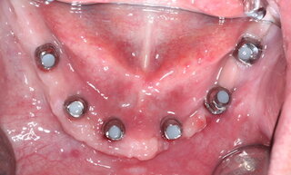 Unterkiefer Implantate @