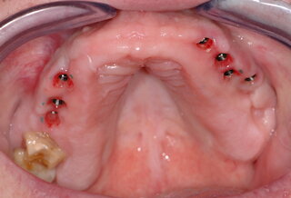 Implantate @