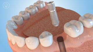 Der defekte Zahn wird entfernt und ein Implantat gesetzt. @ 