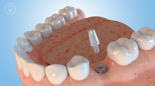 Das Implantat heilt ein. @ 