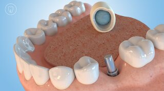 Das Implantat wir zur endgültigen Versorgung vorbereitet. @ 