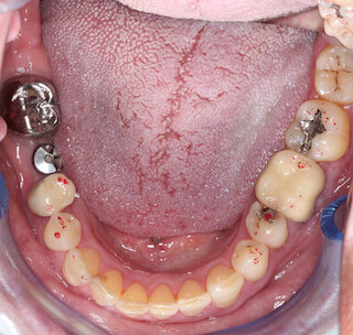 Stahlkrone und Implantat @
