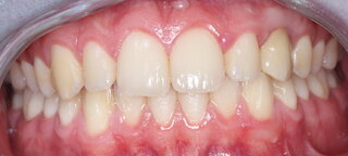 Front Nachher @