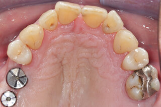 Implantate @