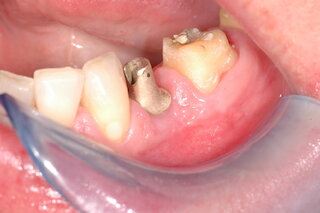 Implantat @